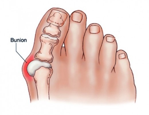 lábujjfájdalom első tünetei az ízületek ízületi gyulladásának enyhítése