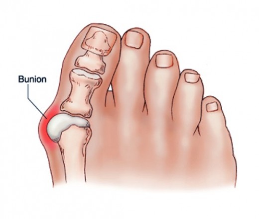 fájó ízület a lábánál a nagy lábujj közelében vállízületi tünetek kezelése